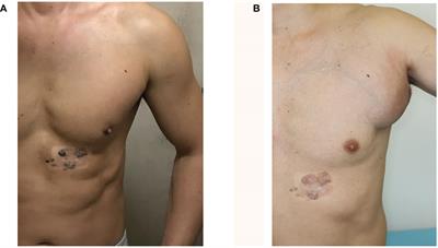 Case report: A case of metastatic BRAFV600-mutated melanoma with heart failure treated with immune checkpoint inhibitors and BRAF/MEK inhibitors